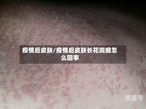 疫情后皮肤/疫情后皮肤长花斑癣怎么回事-第2张图片